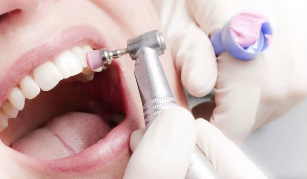 5 причин, почему стоит удалить зубной камень