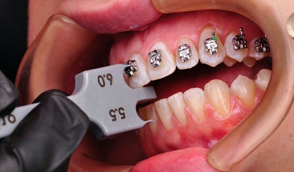 Путеводитель по видам брекетов: Какой выбрать?